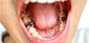 Dental filling Dental Fillings - What You Need to Know